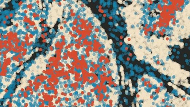 Light gray tumor cells are infiltrated by CCL3-positive (orange) and and CCL3-negative (blue) neutrophils. 