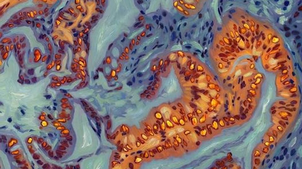 Pancreatic cancer cells with key proteins highlighted in orange, yellow, blue and purple.