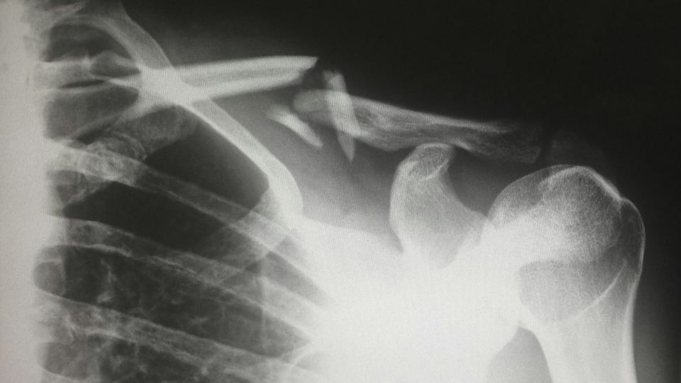 Shoulder X-ray showing a break in the centre of the clavicle.