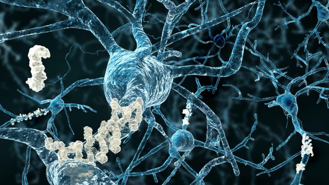 Illustration of neurons covered in plaques. The neurons are blue and the plaques are white.  