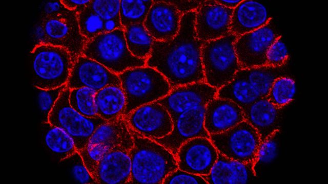 Fluorescent microscopy image of pancreatic cancer cells with blue nuclei and red cell membranes. 