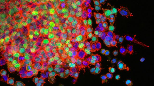 Fluorescent microscopy showing lung cancer metastasis cells with multicolored nuclei and red cytoskeleton network. 