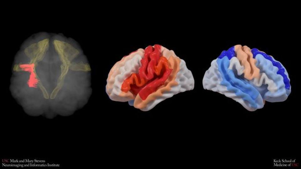 AI Study Reveals Brain Adaptation After Stroke | Technology Networks