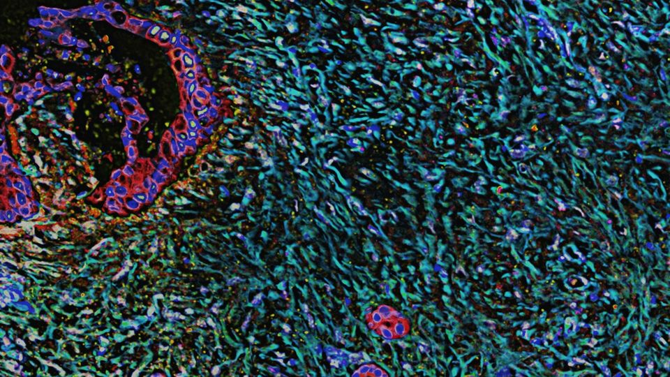 Microscopic image of pancreatic desmoplasia showing dense fibrotic tissue and cellular structures.