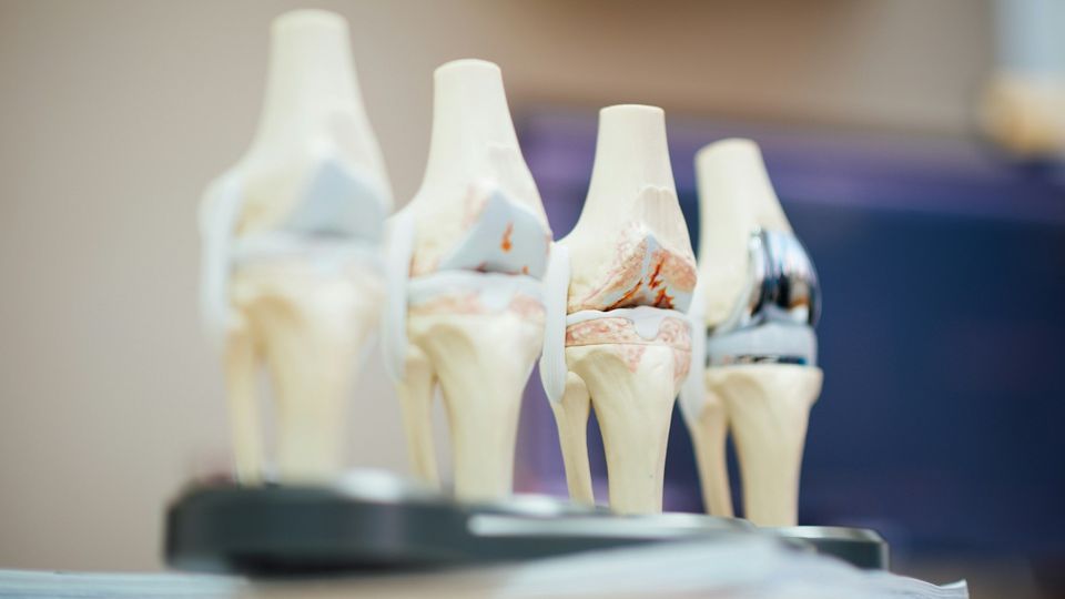 Four knee joint models showing bones, ligaments, and the meniscus at various stages of damage.