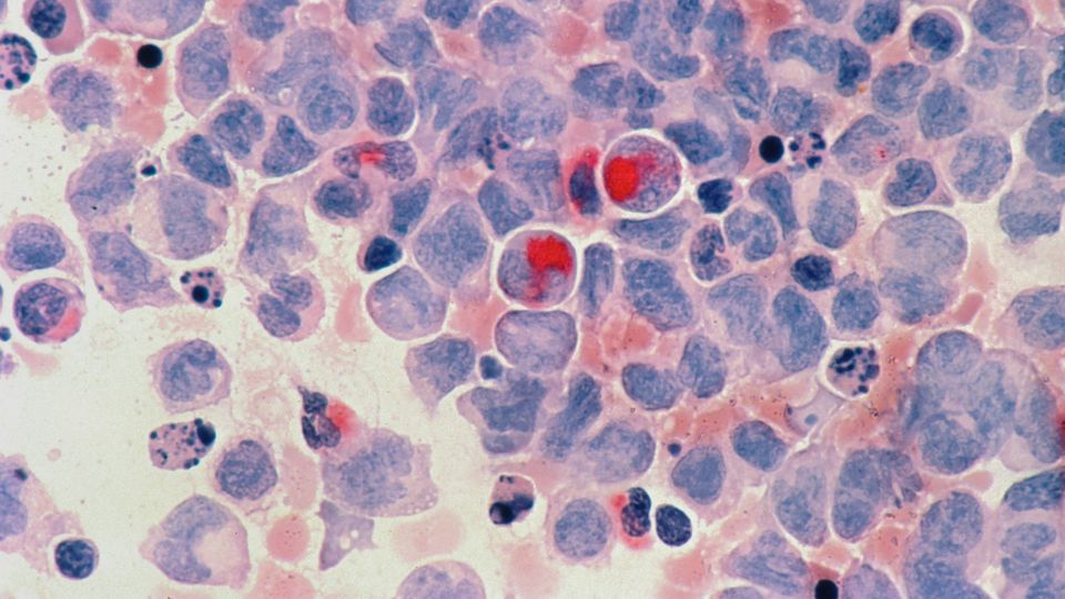 Microscopic image of leukemia cells showing abnormal white blood cell morphology.