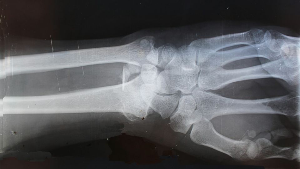 Wrist X-ray showing bones and joints of the human hand and forearm.