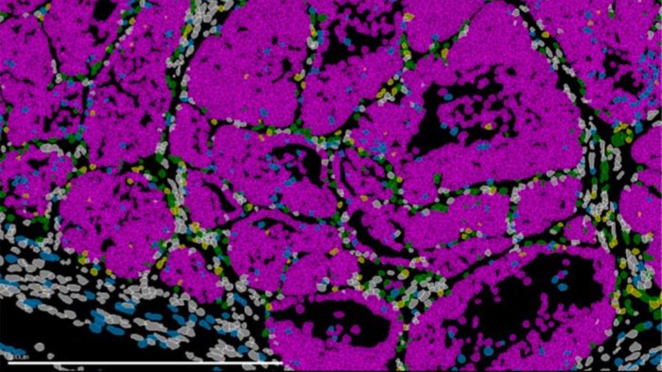 Fluorescent microscopy of mouse breast tumor tissue showing labeled cancer cells and microenvironment.