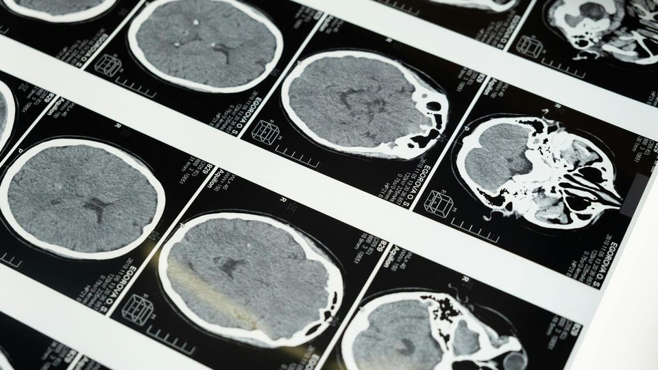 MRI brain scan slices displayed on medical imaging film for diagnostic analysis.