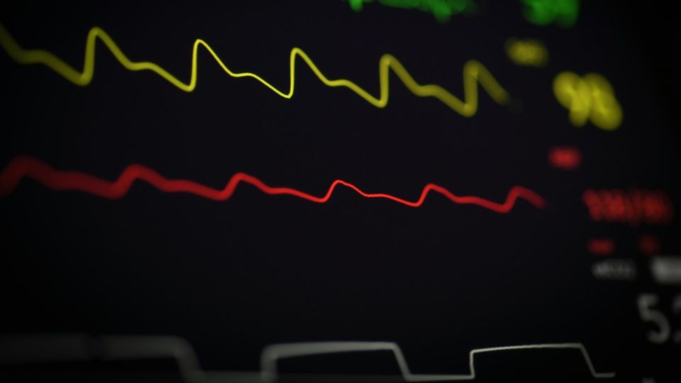 ECG monitor displaying heart rhythm lines.