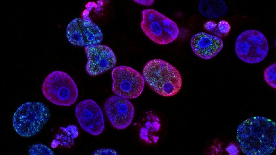 Microscopic view of human cancer cells showing nuclei and cellular structures.