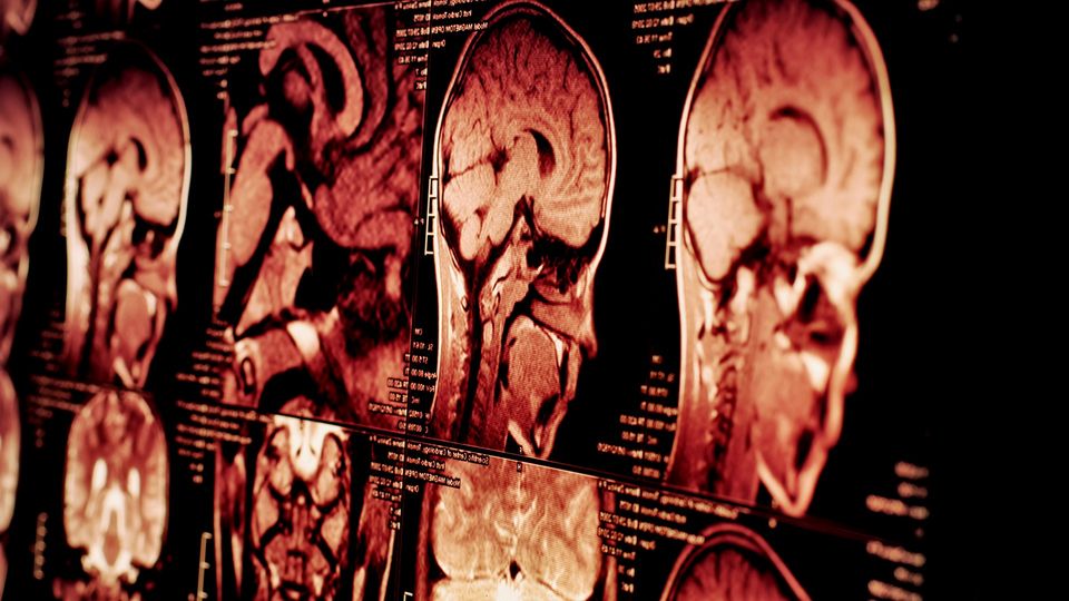 Brain MRI scans in multiple views displayed on screen, illustrating neuroimaging analysis.
