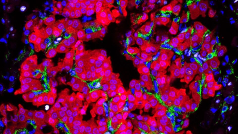 Fluorescent microscopy image of tumor cells with stained nuclei and cellular structures.