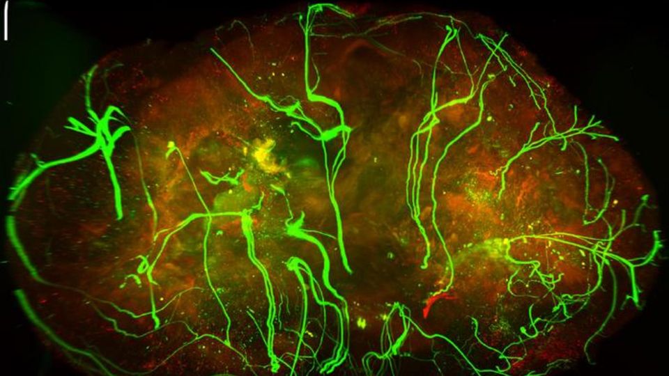 Melanoma tumor tissue with highlighted nerve cells.