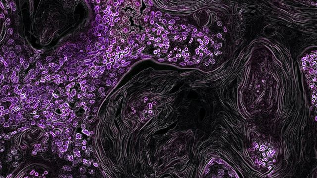 YAP1 Protein Tied to Lung Cancer Chemotherapy Resistance | Technology ...