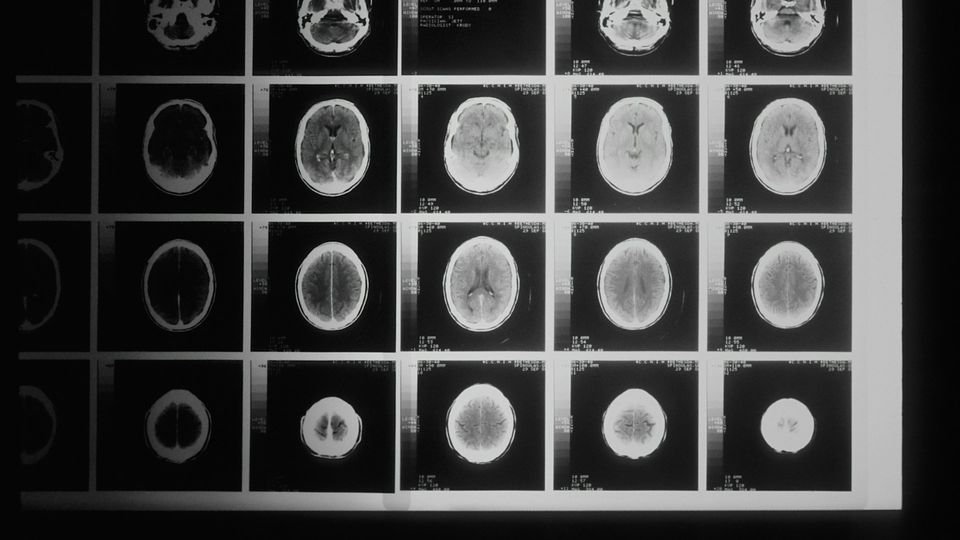 MRI scan images of the human brain displayed on a diagnostic medical imaging panel.