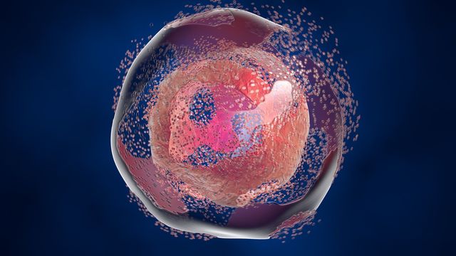 A cell undergoing lysis as a result of cellular senescence. 