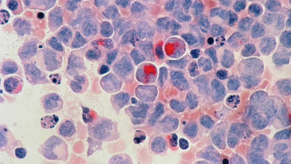 Microscopic image of acute myelocytic leukemia cells in a immunohistochemical sample.