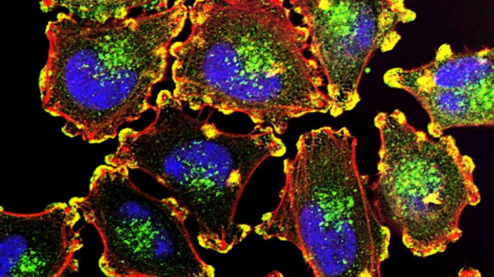 Fluorescent microscopy image of melanoma cells.