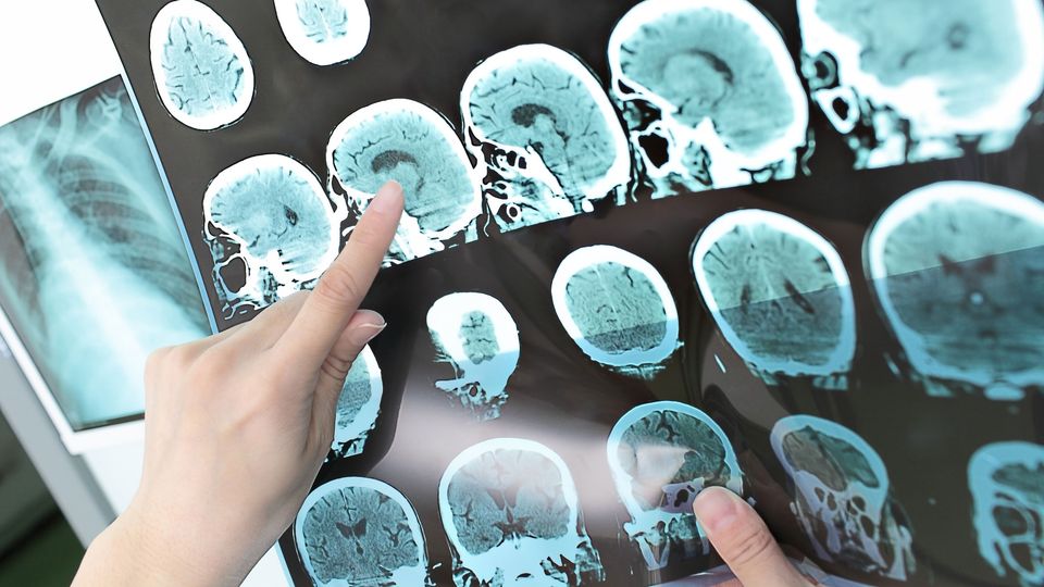 Hands pointing to brain scan images on medical display, illustrating brain imaging analysis.