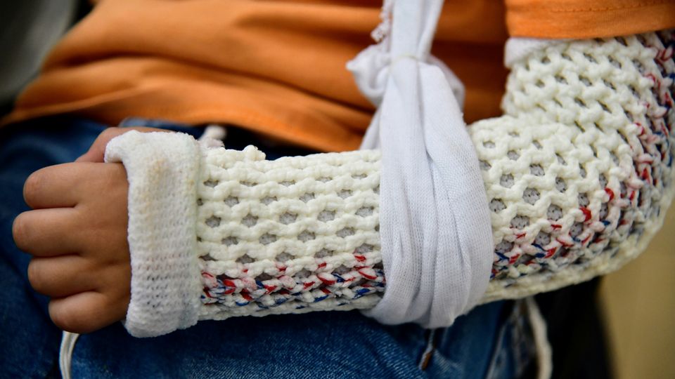 A person with a broken arm, with that arm in a white cast and sling.