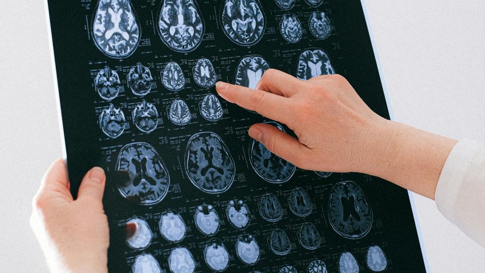 Doctor reviewing brain scan images for neurological diagnosis.