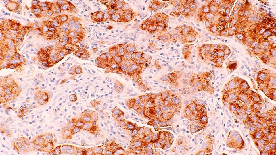 Microscopic image of breast cancer cells with visible structures including nuclei due to staining.