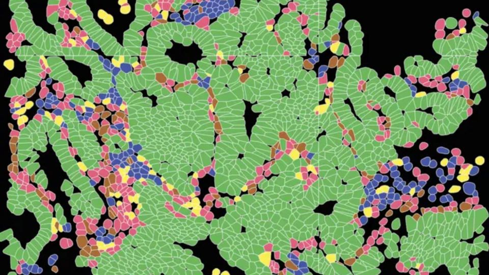 Illustration of colorectal cancer cells and tissue structures.