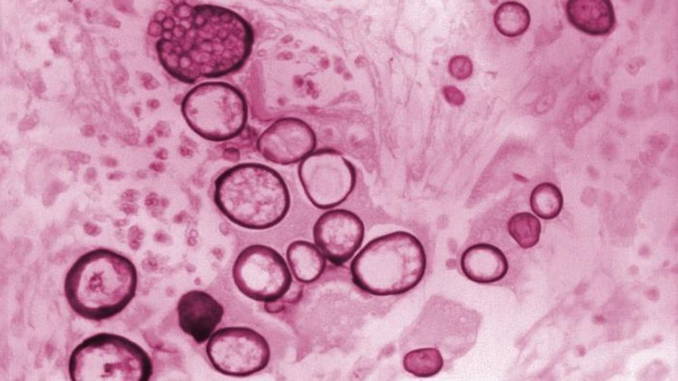Microscopic view of Coccidioides sp. spherules in a stained tissue section.
