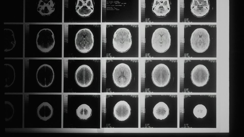 MRI scan film displaying multiple cross-sectional brain images.