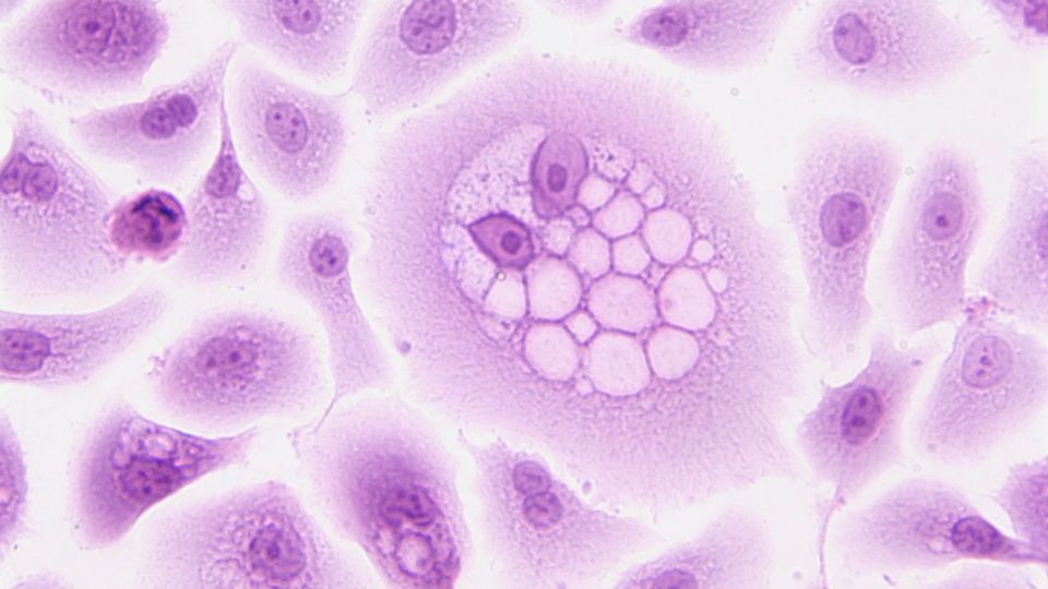 Microscopic view of stained oncoprotein cells with enlarged nuclei and clustered cell structures.