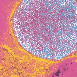 Microscopic view of human fibroblasts reprogrammed into induced pluripotent stem cells (iPSCs).