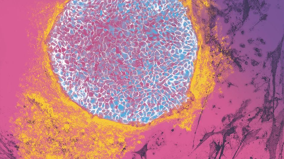 Microscopic view of human fibroblasts reprogrammed into induced pluripotent stem cells (iPSCs).