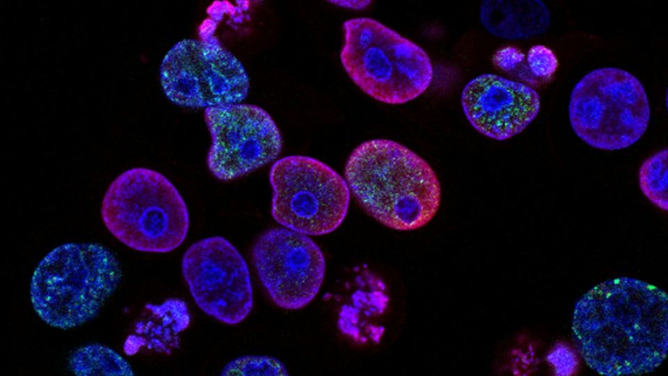 Microscopic view of a cluster of human cancer cell structures undergoing cellular division.