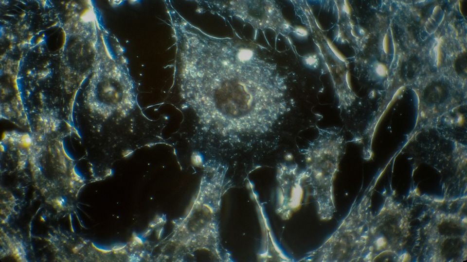 Microscopic image of cancer cells showing irregular cellular structures and nuclei in gray and black.