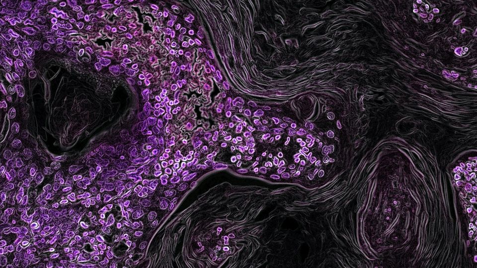 Microscopic image of cancer cells and tissue structures.