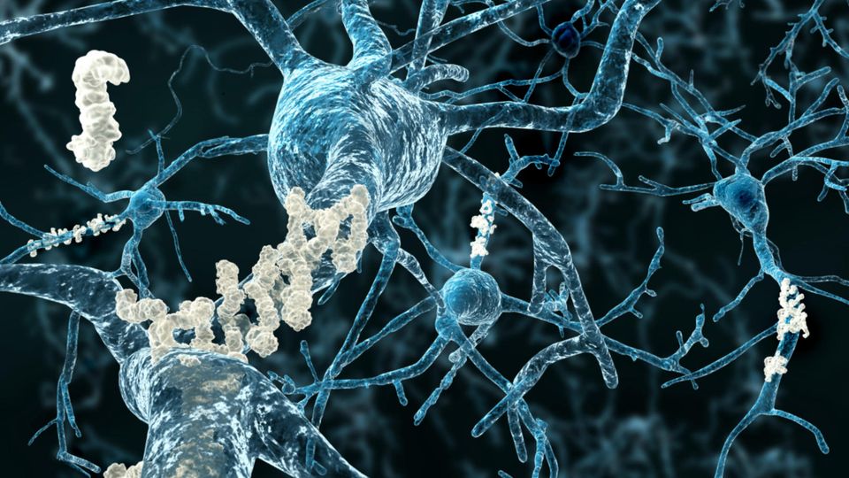 Render of neuronal network in blue, showing body of a neuron and dendrites, with one area covered in white plaques.
