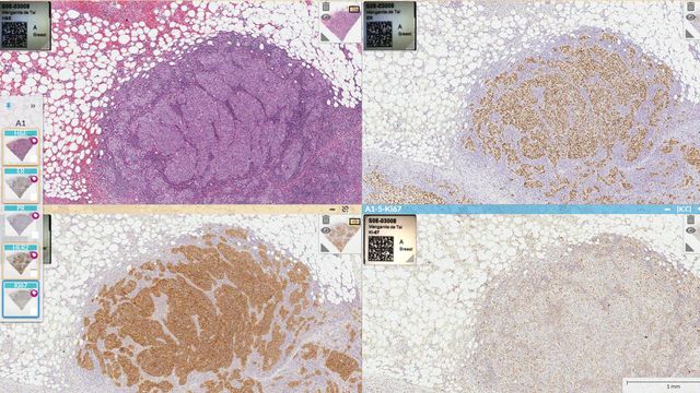 Four pathology slide images aligned side-by-side. 