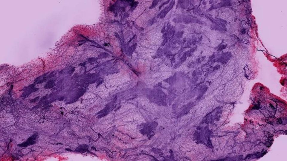 Microscopic breast tissue sample stained for histology analysis.