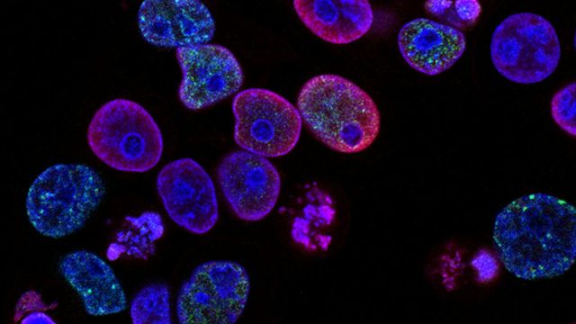 Fluorescent microscopy image of cancer cells showing stained nuclei and cellular structures. 
