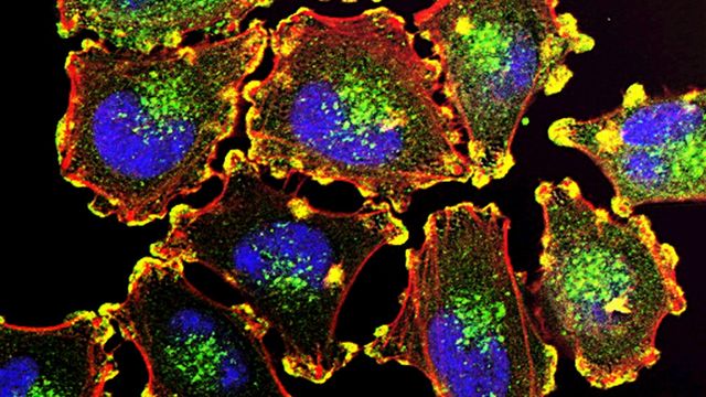 Fluorescent microscopy image of cancer cells with highlighted nuclei and cellular structures. 
