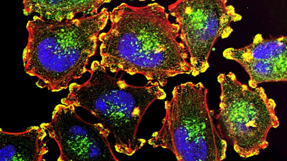 Fluorescent microscopy image of cancer cells with highlighted nuclei and cellular structures.