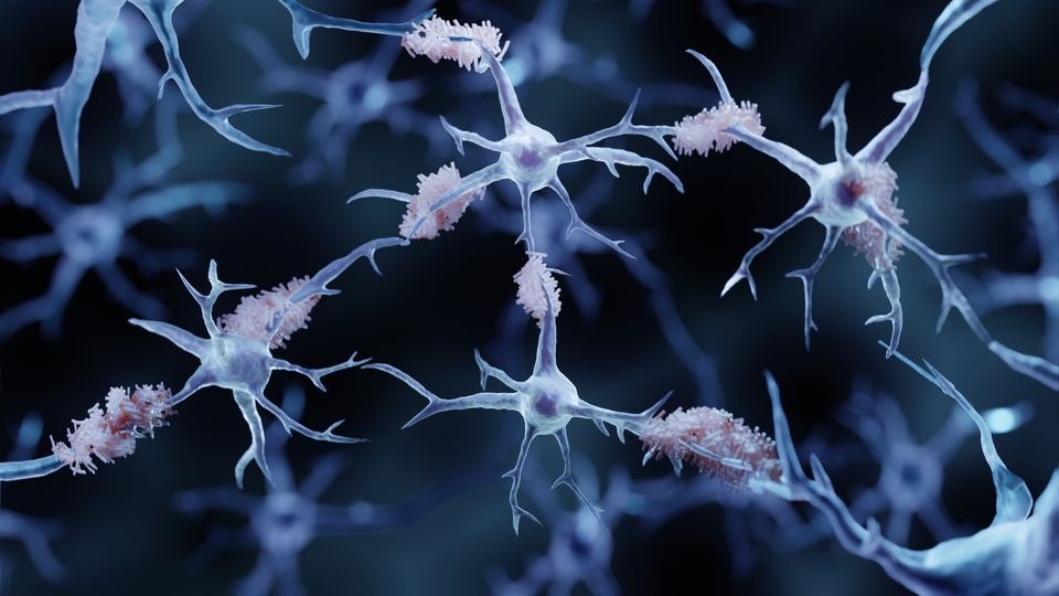 Render of neuronal network in gray, showing neuronal bodies and dendrites, with areas covered in plaques.