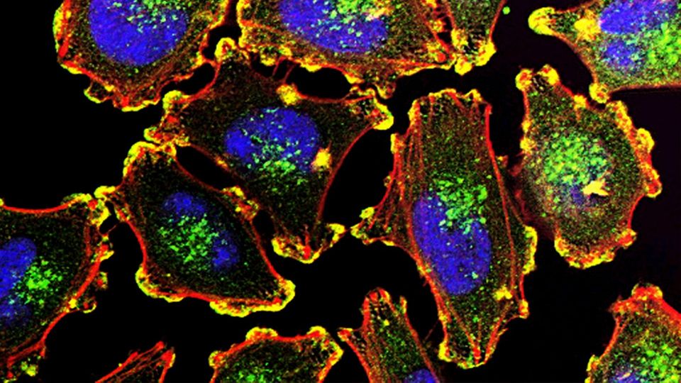 Fluorescent microscope image of cancer cells showing stained nuclei and cellular structures.