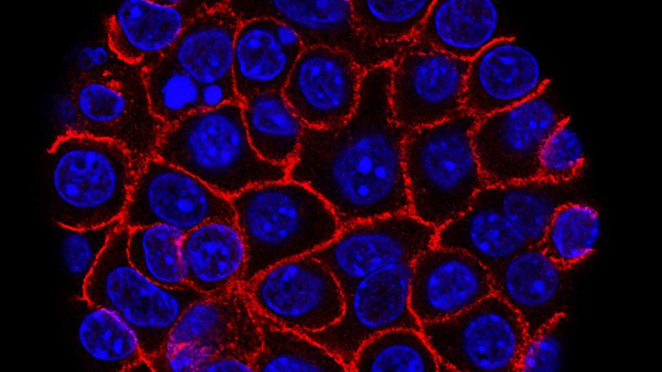 Fluorescent microscopy image of cancer cells with blue-stained nuclei and red cell membranes.