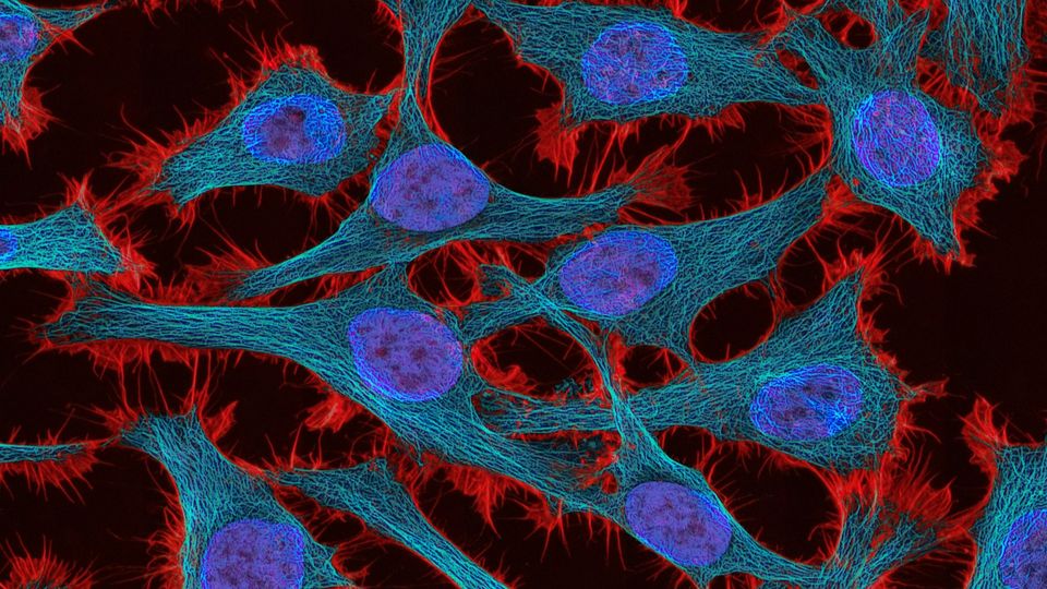 Fluorescent microscopy image of cancer cells showing stained nuclei and cellular structures.