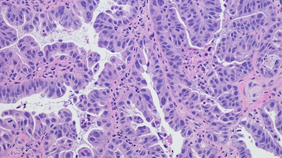 Microscopic view of cancer tissue showing abnormal cell growth.