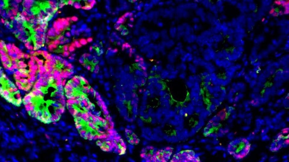 Fluorescent microscopy image of mouse colon cancer tissue.
