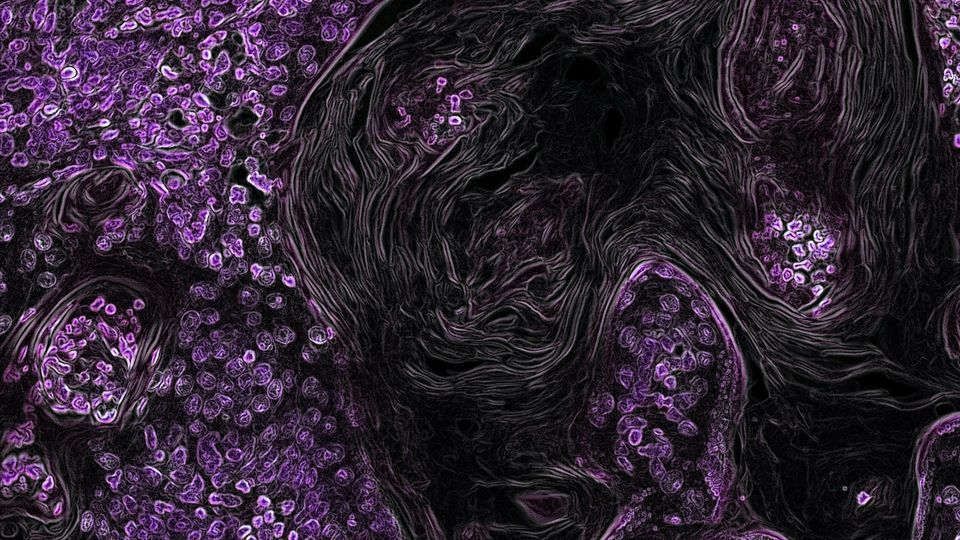 Microscopic view of clusters of lung cancer cells surrounded by dense fibrous tissue structures.