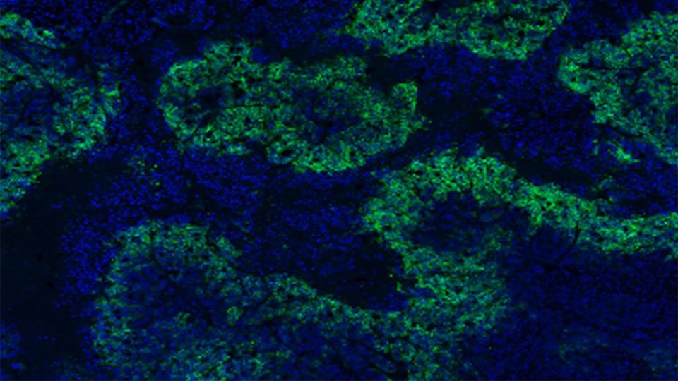 Microscopic view of hypoxic regions within a colorectal tumor cell structure.